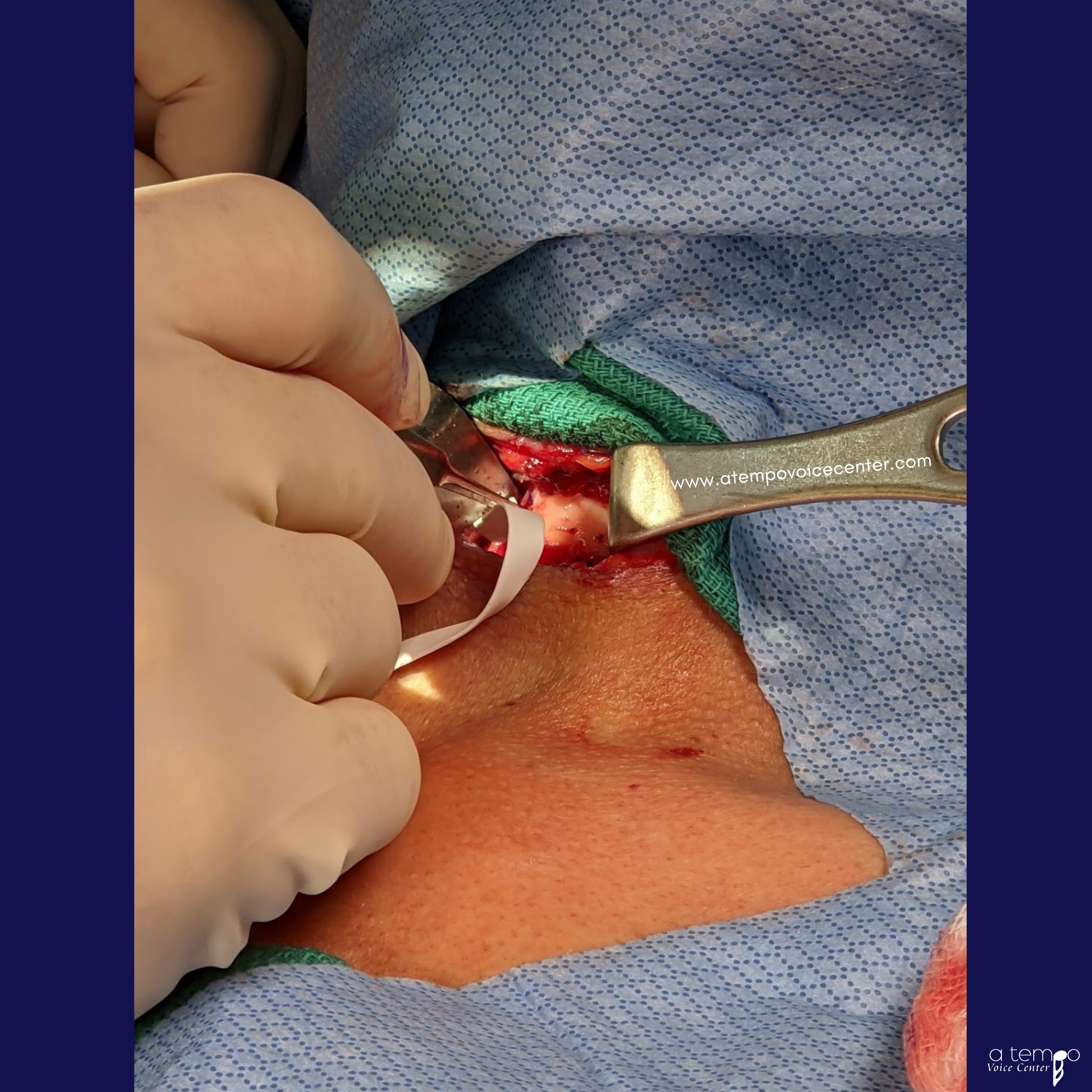 The gortex strip is carefully moved into each hole until the desired distance is achieved for the vocal folds to come to midline.