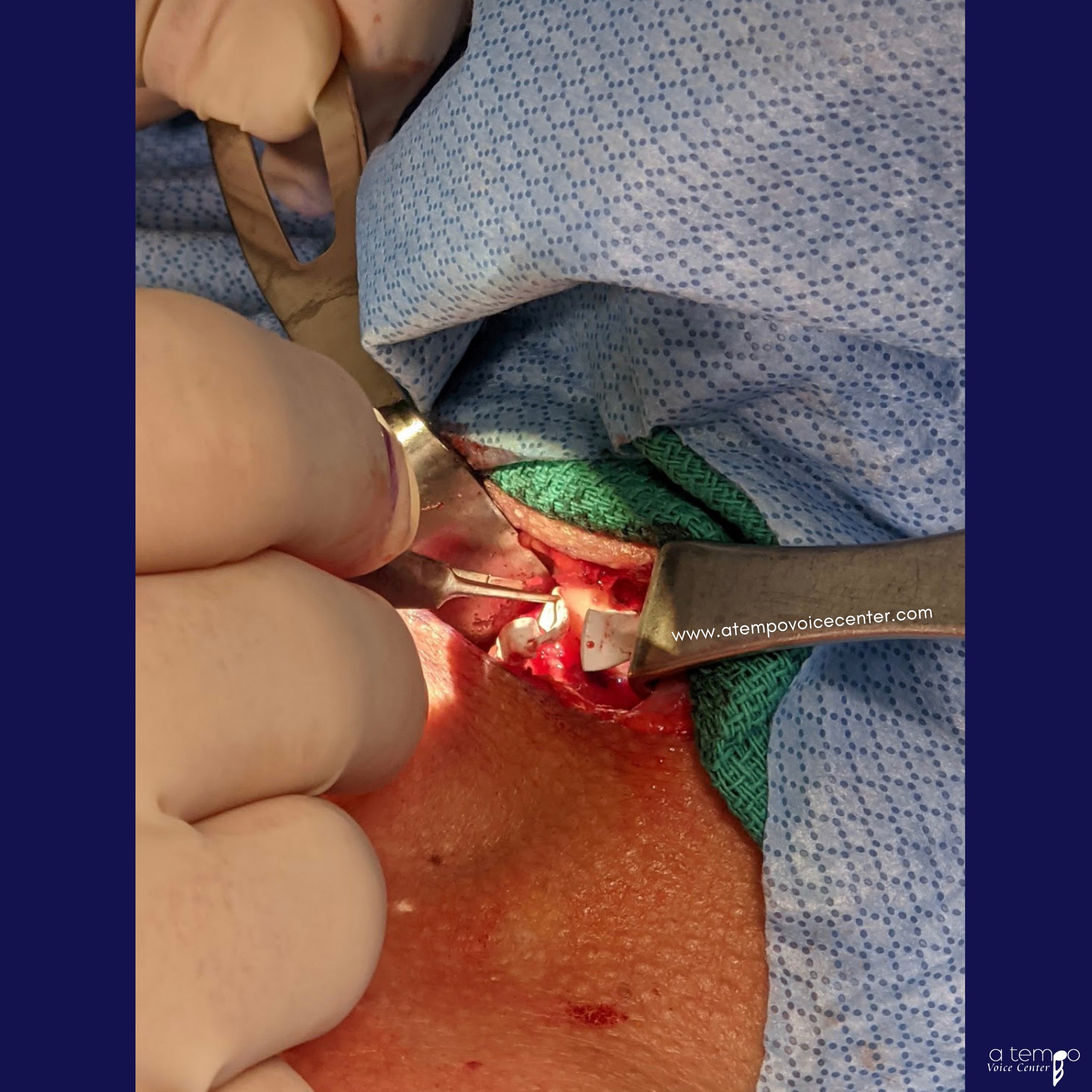 The patient was awakened slightly to vocalize by counting to determine how much should be placed. The better they sounded, the less the gortex was moved inward into the holes.