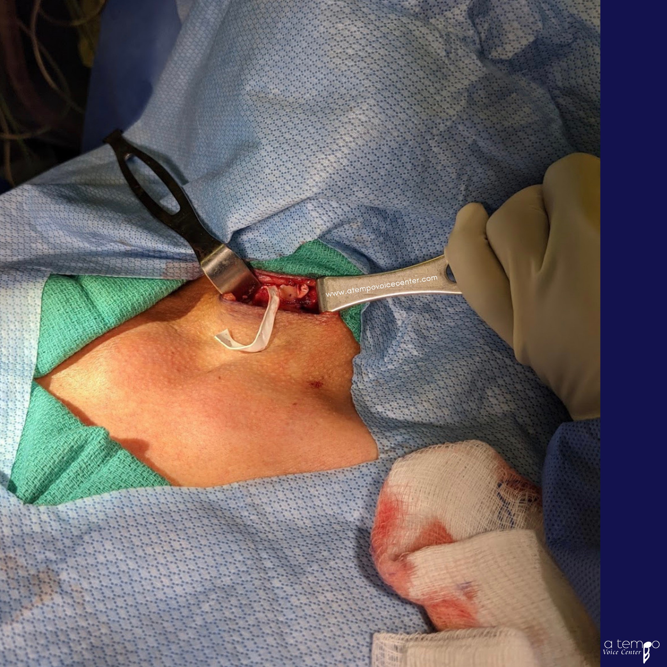 Multiple trials of this voicing were completed to make sure it was a go. This is the art of the procedure and why surgeons truly have such a huge role in voice improvement.