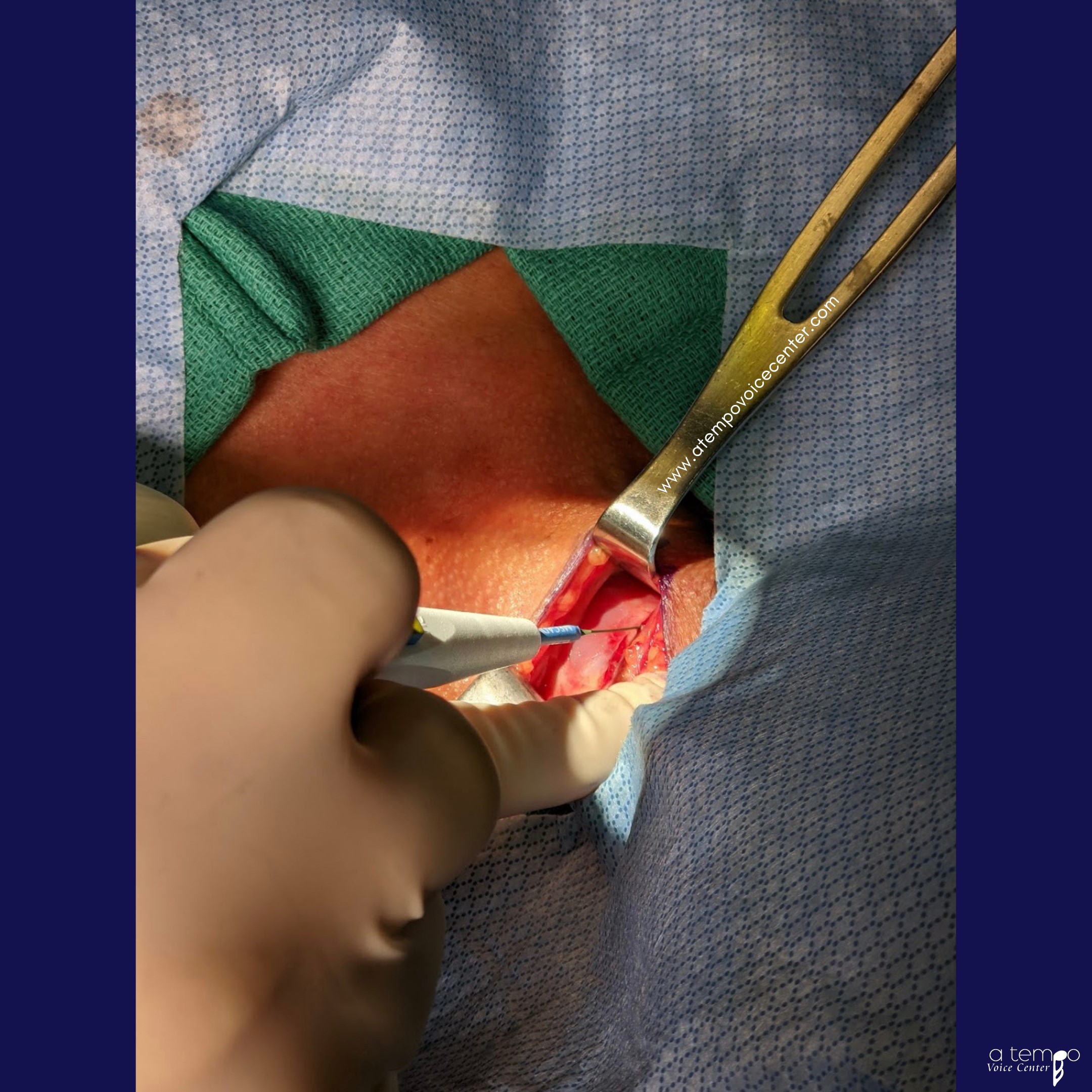 Muscle was retracted as well, to better reach the thyroid cartilage.