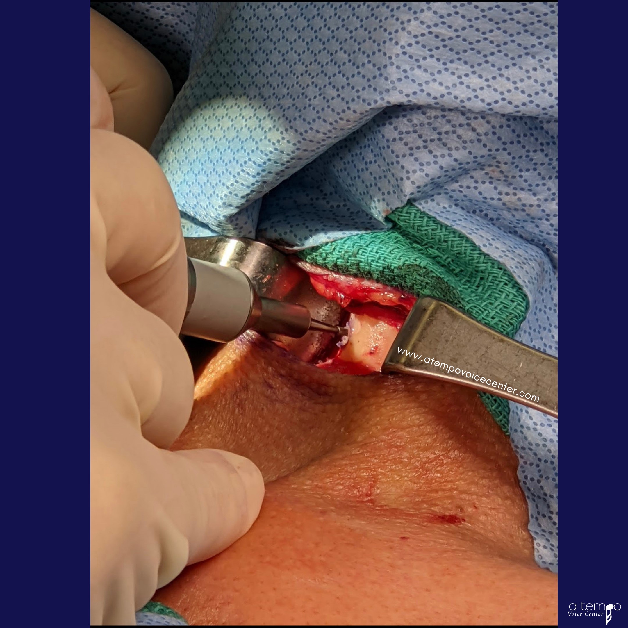 A second hole was made on the patient’s right side, mirroring the first hole through the thyroid cartilage.